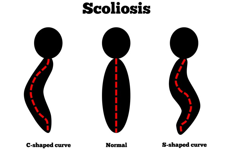 Stillwater, MN scoliosis treatment